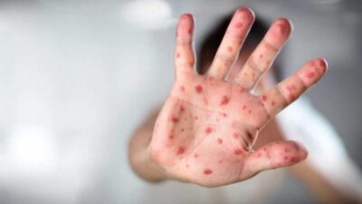 كبير أطباء أونتاريو يحذر من إمكانية تفشي مرض الحصبة بين الأطفال