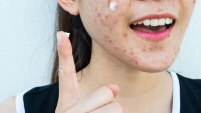 كندا تحقق في وجود منتجات لمعالجة حب الشباب تحتوي على البنزين!