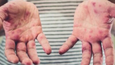 أونتاريو تشتري دفعة جديدة من لقاحات الحصبة