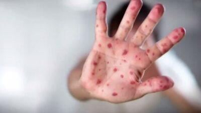 تسجيل اصابة جديدة بالحصبة في تورونتو … والأطباء يحذرون
