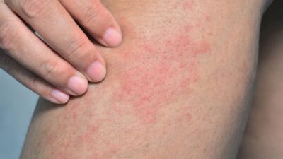سحب دواء لعلاج الحكة والالتهامات في كندا بسبب مخاطر صحية