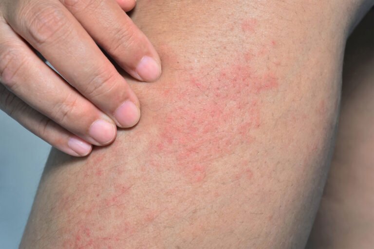 allergic rash on the leg GettyImages 2006598052 3000x2000 1