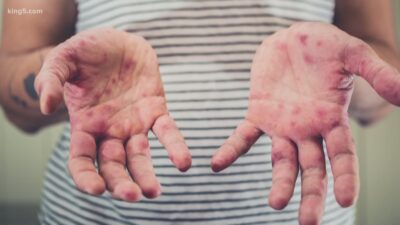 كندا تعلن رسمياً انتهاء تفشي الحصبة الذي استمر عامين في 10 مقاطعات وأقاليم